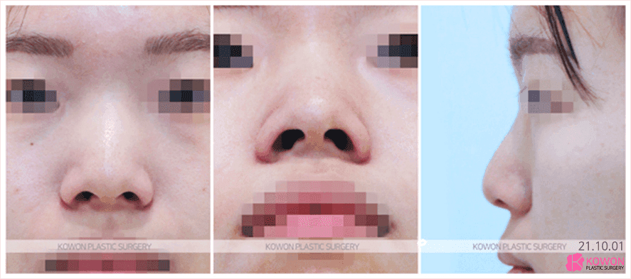 주먹코는 왜 얼굴 전체를 답답해 보이게 하나요 — 연부조직·연골·콧볼을 함께 보는 이유 관련 이미지 3/8