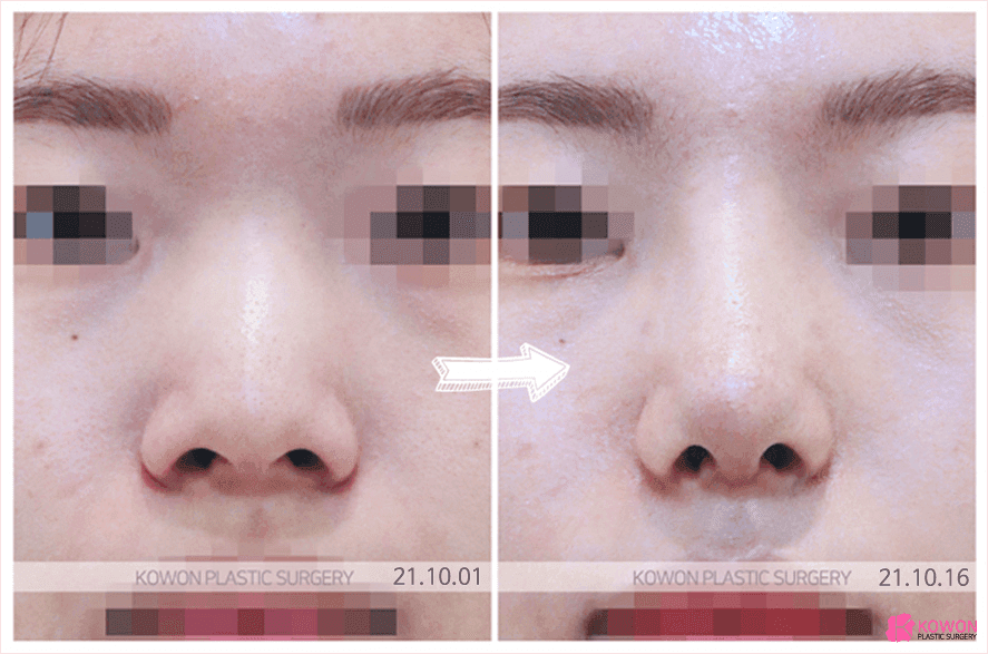 주먹코는 왜 얼굴 전체를 답답해 보이게 하나요 — 연부조직·연골·콧볼을 함께 보는 이유 관련 이미지 4/8