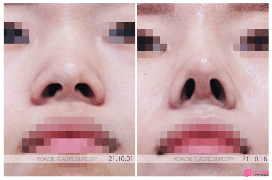 주먹코는 왜 얼굴 전체를 답답해 보이게 하나요 — 연부조직·연골·콧볼을 함께 보는 이유 관련 이미지 5/8