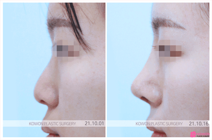 주먹코는 왜 얼굴 전체를 답답해 보이게 하나요 — 연부조직·연골·콧볼을 함께 보는 이유 관련 이미지 6/8