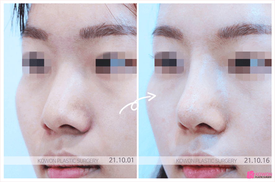 주먹코는 왜 얼굴 전체를 답답해 보이게 하나요 — 연부조직·연골·콧볼을 함께 보는 이유 관련 이미지 7/8