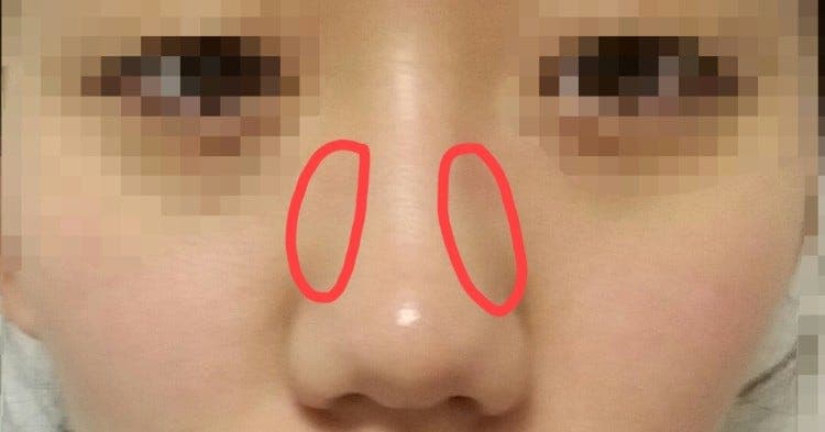 복코수술, 절골과 콧볼축소를 꼭 해야 하나요? — 코끝 수술로 충분한 경우 관련 이미지 3/5
