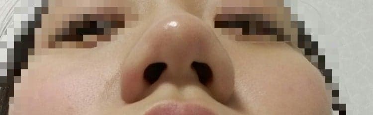 การผ่าตัดปลายจมูกกลมใหญ่เกินไป จำเป็นหรือไม่ที่จะต้องทำการตัดกระดูกและการลดปีกจมูก? — กรณีที่การผ่าตัดปลายจมูกเพียงอย่างเดียวก็เพียงพอแล้ว ภาพที่เกี่ยวข้อง 4/5