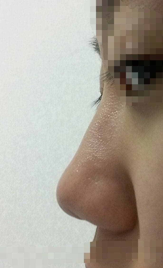 복코수술, 절골과 콧볼축소를 꼭 해야 하나요? — 코끝 수술로 충분한 경우 관련 이미지 5/5