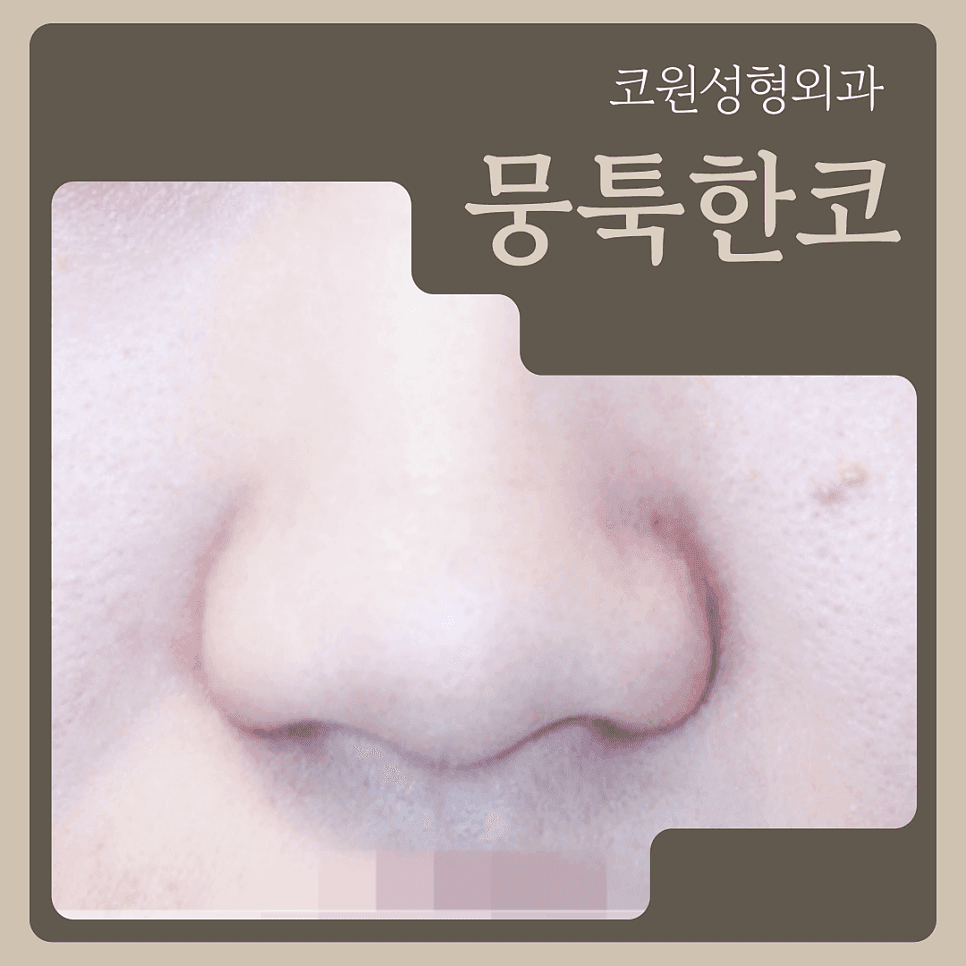 Image 1/5 for blunt nose correction — why bridge and nasolabial angle are considered together, not just the tip
