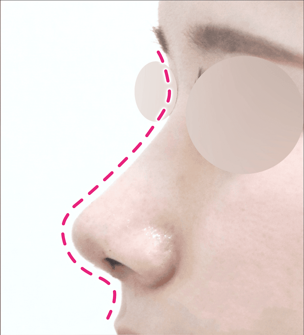 Image 2/5 for blunt nose correction — why bridge and nasolabial angle are considered together, not just the tip
