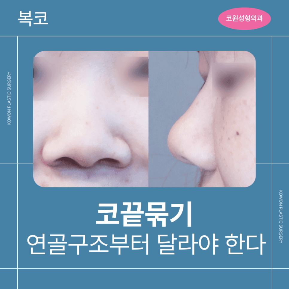 ภาพที่เกี่ยวข้องกับการเย็บปลายจมูก ปลายจมูกกลมใหญ่จมูกที่สามารถทำได้โดยการรวบกระดูกอ่อนเพียงอย่างเดียว เทียบกับจมูกที่ต้องพิจารณาถึงสันจมูกด้วย 1/5