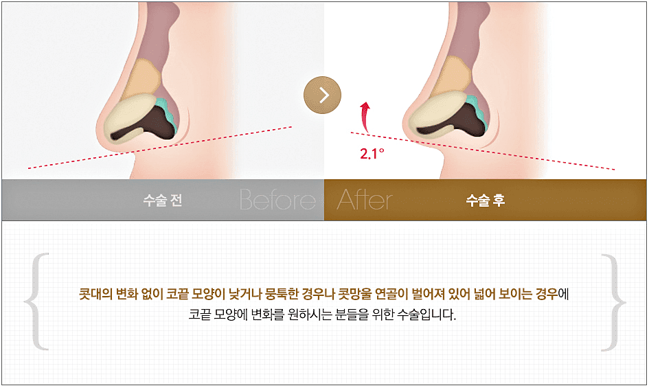 복코 코끝묶기, 연골만 모아서 되는 코와 콧대까지 봐야 하는 코 관련 이미지 3/5