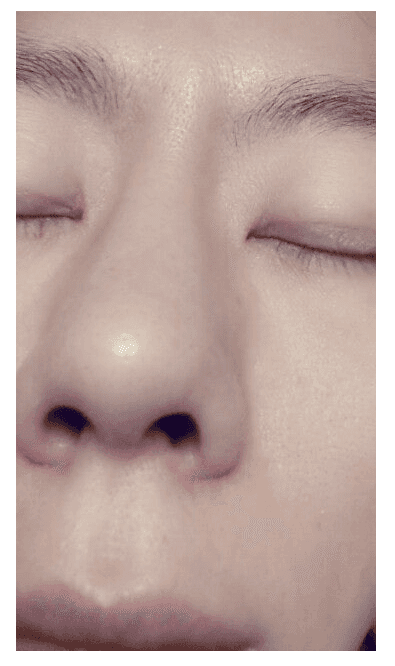 복코수술 46일 차, 붓기 때문에 인위적으로 보이면 재수술을 생각해야 하나요? 관련 이미지 4/8