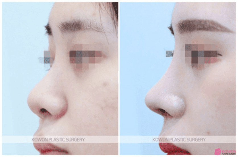 복코 코끝성형, 코끝만 다듬으면 안 되는 이유 — 비율과 지지 구조로 보는 사례 관련 이미지 3/5