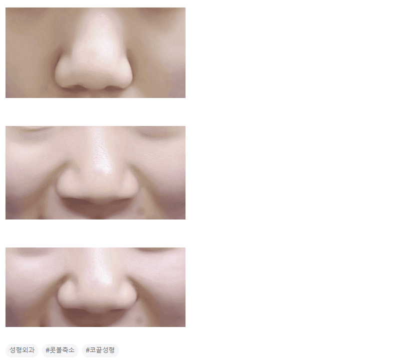 웃을 때 퍼진코가 심해집니다 — 손가락으로 확인하는 방법과 비중격 내림근 관련 이미지 3/3