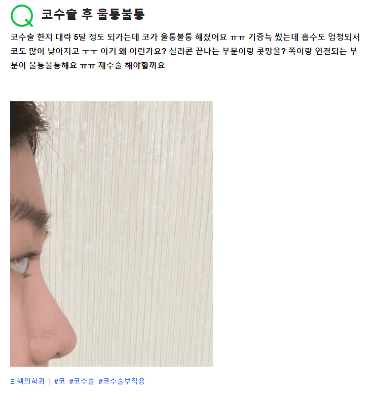 코수술 5개월, 코가 울퉁불퉁해 보이면 재수술해야 하나요? — 걱정될 때 확인 순서 관련 이미지 2/2