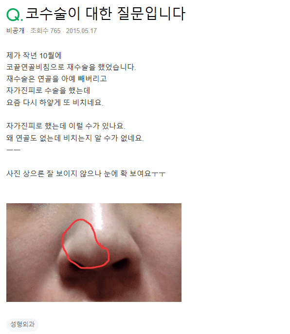 진피지방 이식으로 연골비침 재수술을 했는데 또 비쳐요 — 흡수를 의심하는 이유 관련 이미지 2/2