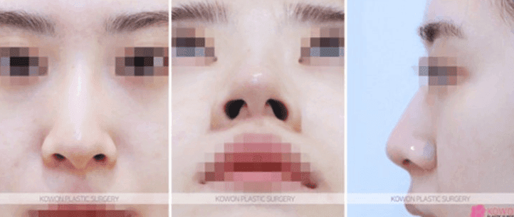 비개방 코수술로도 절골이 가능할까 — 전신마취 걱정까지 정리 관련 이미지 4/10