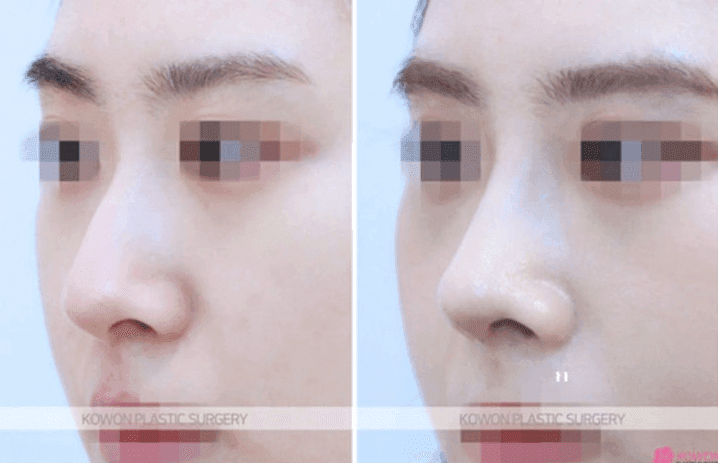 비개방 코수술로도 절골이 가능할까 — 전신마취 걱정까지 정리 관련 이미지 6/10