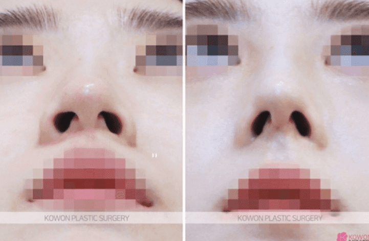 비개방 코수술로도 절골이 가능할까 — 전신마취 걱정까지 정리 관련 이미지 8/10
