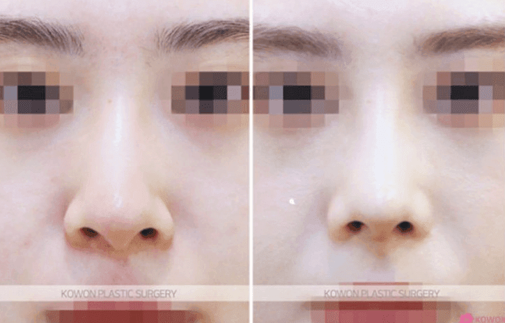 비개방 코수술로도 절골이 가능할까 — 전신마취 걱정까지 정리 관련 이미지 9/10
