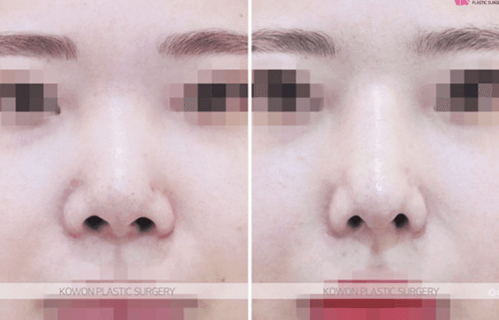 หากปลายคอลูเมลลาดูยุบลง 1 ปี 6 เดือนหลังศัลยกรรมจมูก— ขั้นตอนในการตรวจสอบว่าเป็นผลข้างเคียงหรือจำเป็นต้องผ่าตัดแก้ไขหรือไม่ ภาพประกอบ 6/10