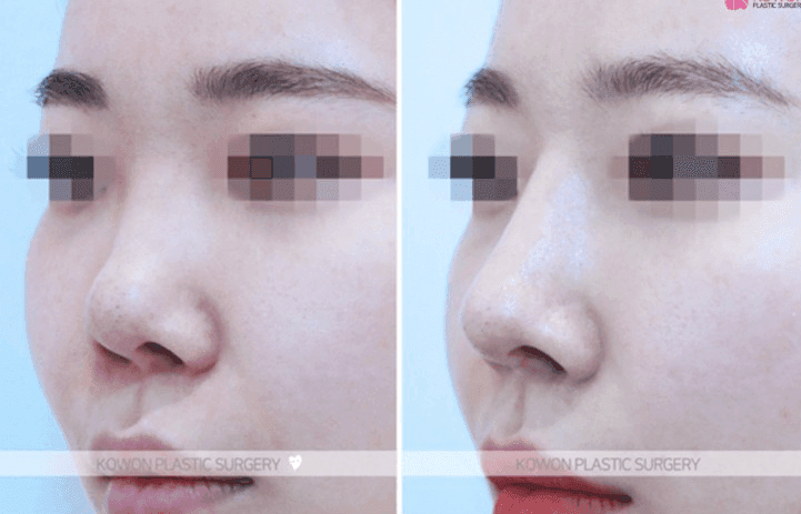 코성형 1년 6개월 뒤 비주가 움푹 패어 보인다면 — 부작용인지 재수술이 필요한지 판단하는 순서 관련 이미지 8/10
