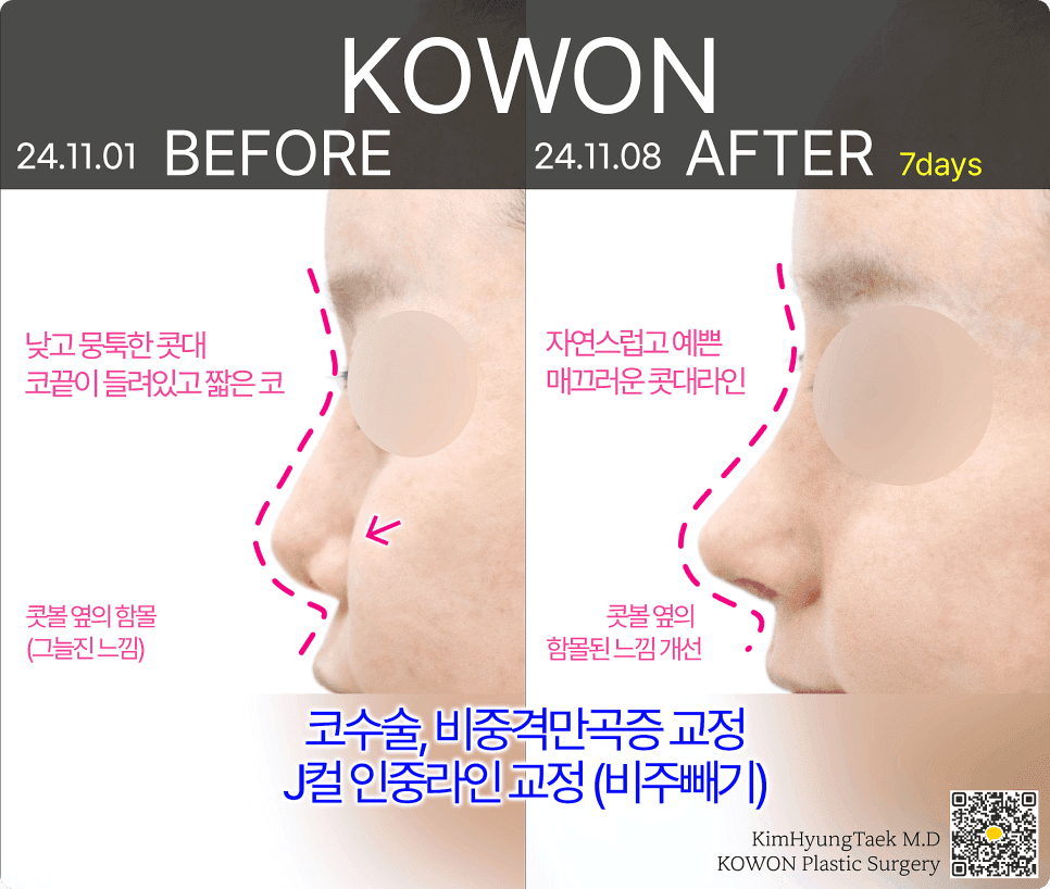 비주내리기, 들창코 교정에서 각도 설계가 중요한 이유 관련 이미지 4/4