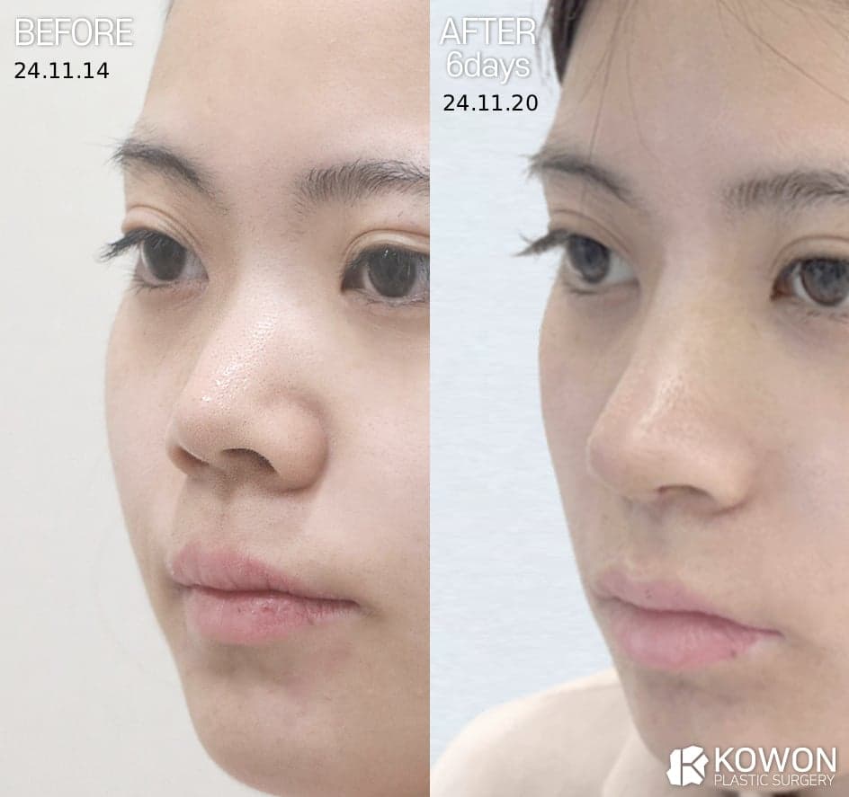 비주내리기, 짧은코와 콧구멍 노출 — 비순각만의 문제가 아닌 이유 관련 이미지 3/5