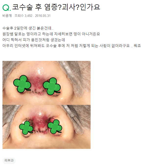 수술 이틀째 비주에 생긴 붉은 자국, 괴사나 염증일까 — 중력과 피고임을 먼저 봅니다 관련 이미지 2/2