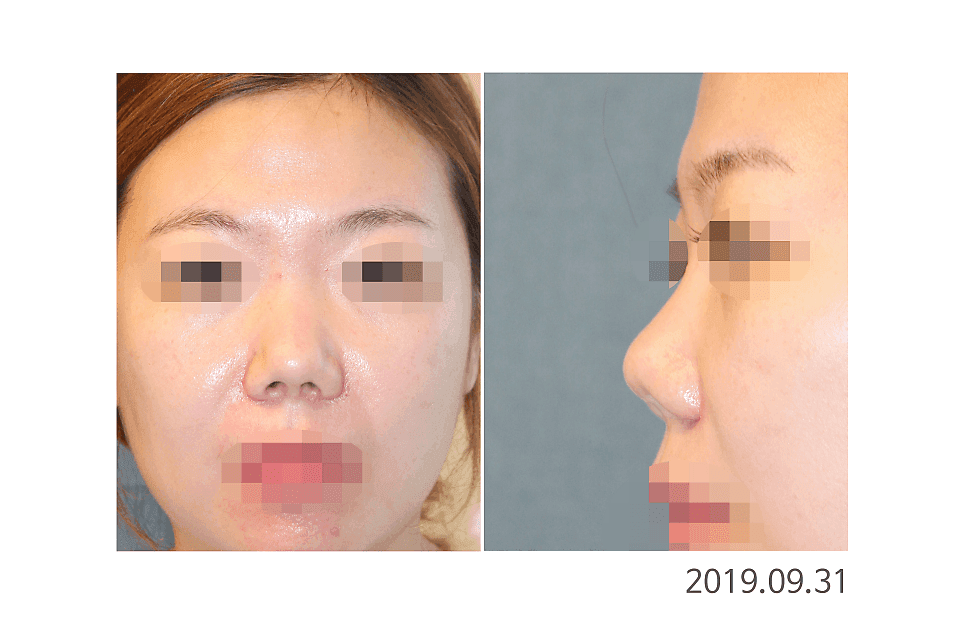 拘縮鼻の再手術、復元は何が違うのか——自家組織でアプローチする理由 関連画像 3/6