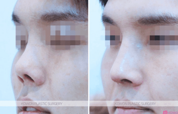 กรณีศึกษาเกี่ยวกับการแก้ไขจมูกหดรั้งที่เชิดขึ้นและสั้นลงด้วยกระดูกอ่อนซี่โครงของตนเอง (ดูภาพที่เกี่ยวข้อง 8/9)