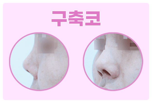 구축코 증상, 어떻게 알아차리나요? — 실리콘 보형물과 구축의 원인, 자가늑연골로 접근하는 이유 관련 이미지 1/8