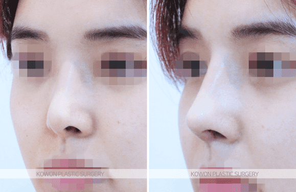 코수술 후 부딪혀 비뚤어진 코, 지병이 있어도 재수술할 수 있나요? — 가능 조건과 비용 고려 관련 이미지 4/5