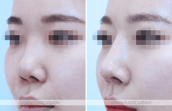 코수술 후 부딪혀 비뚤어진 코, 지병이 있어도 재수술할 수 있나요? — 가능 조건과 비용 고려 관련 이미지 5/5