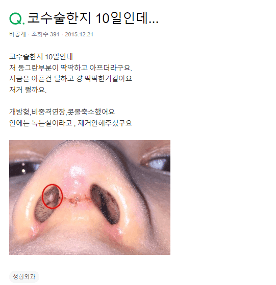 코수술 10일차, 코 안쪽에 딱딱한 것이 만져진다면 — 절개 부위 회복 과정에서 겪는 변화 관련 이미지 2/2