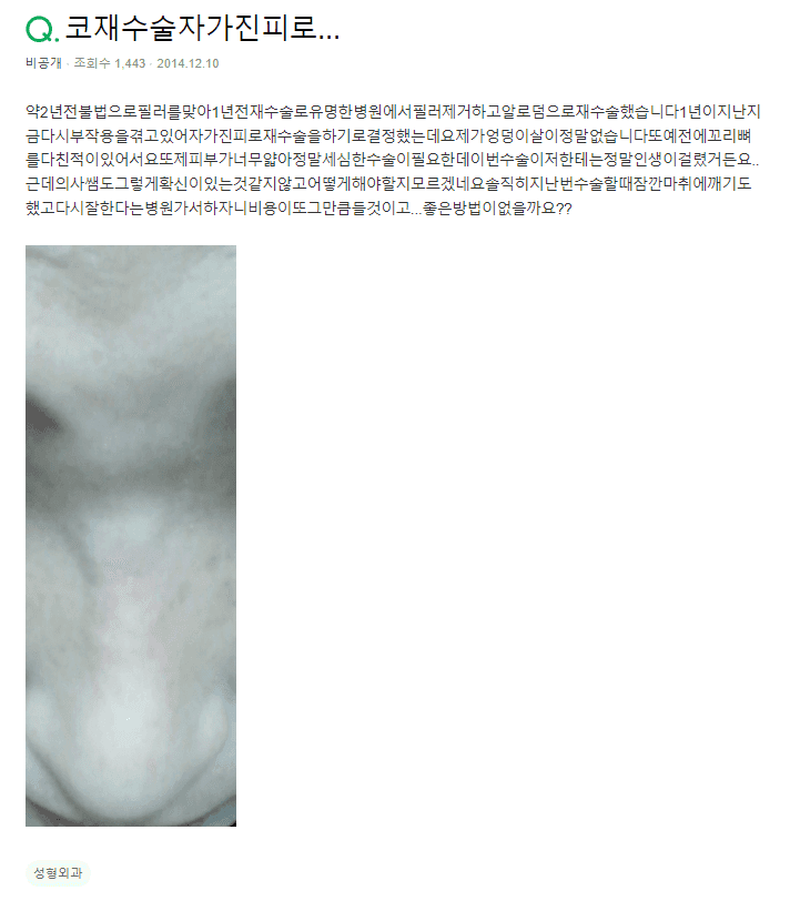 填充物副作用后的自体真皮修复手术——残留填充物成为变量的原因 相关图片 2/2