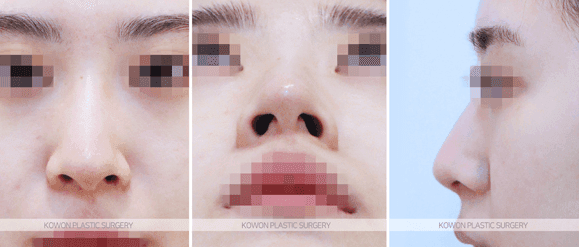 휜코성형을 하면 복코도 함께 좋아질까 — 비대칭과 퍼진 코끝을 같이 정리한 사례 관련 이미지 4/9