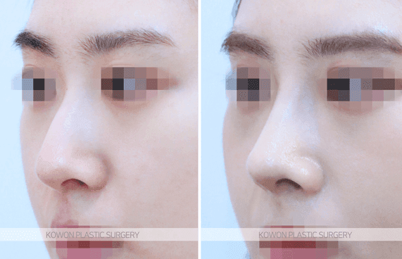 휜코성형을 하면 복코도 함께 좋아질까 — 비대칭과 퍼진 코끝을 같이 정리한 사례 관련 이미지 5/9