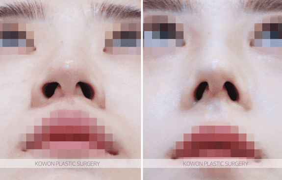 휜코성형을 하면 복코도 함께 좋아질까 — 비대칭과 퍼진 코끝을 같이 정리한 사례 관련 이미지 7/9