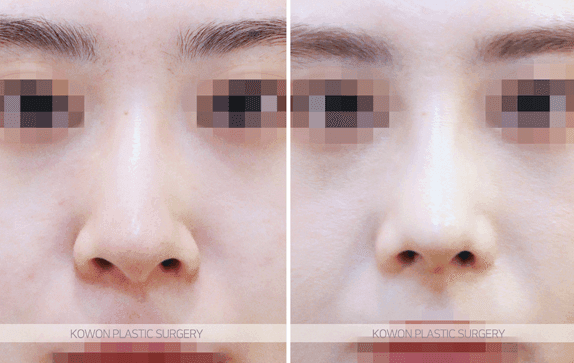 휜코성형을 하면 복코도 함께 좋아질까 — 비대칭과 퍼진 코끝을 같이 정리한 사례 관련 이미지 8/9