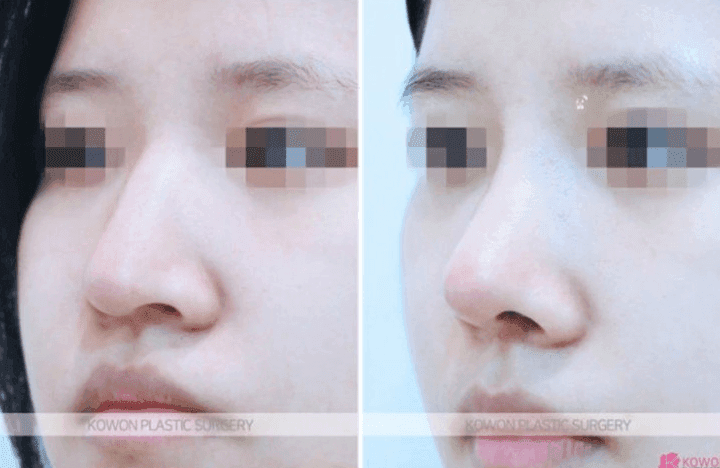 휜코수술, 보험이 되나요 — 외상으로 비대칭이 된 코 질문 4가지에 답하다 관련 이미지 4/5
