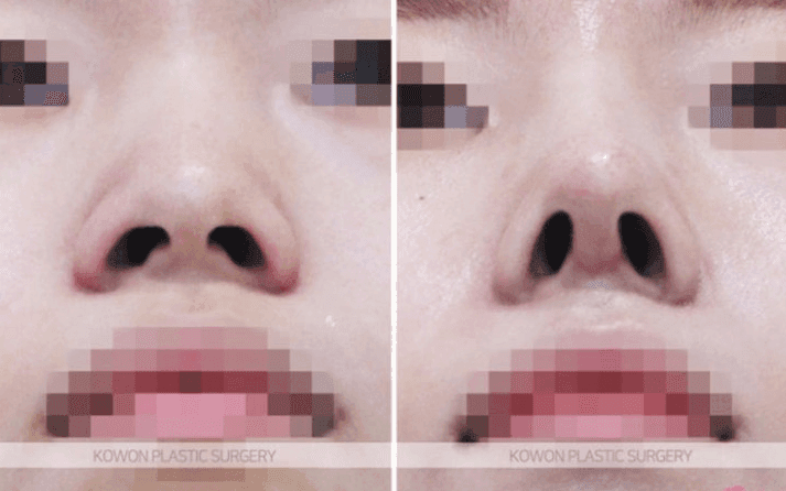 휜코 재수술, 코뼈 절골로 가능할까요 — 건강 상태·비용에서 확인할 것 관련 이미지 5/5