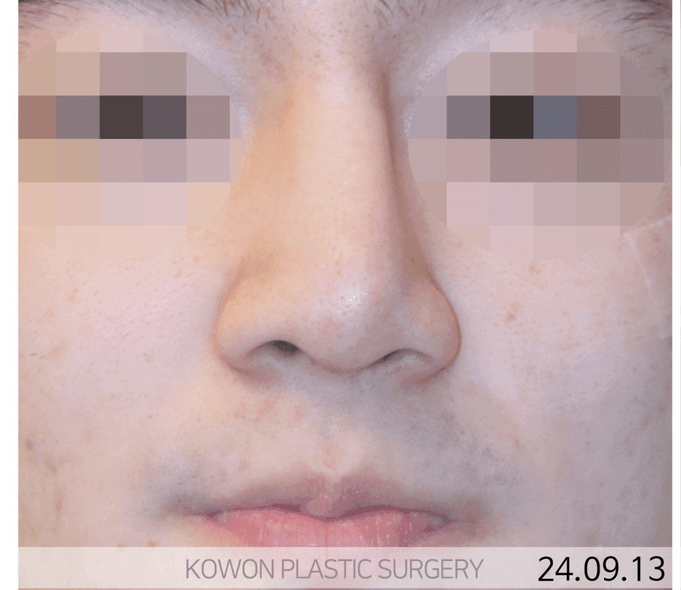 휜코수술, 어디서부터 시작해야 할까 — 비중격을 먼저 세우는 이유와 늑연골 선택 관련 이미지 3/8
