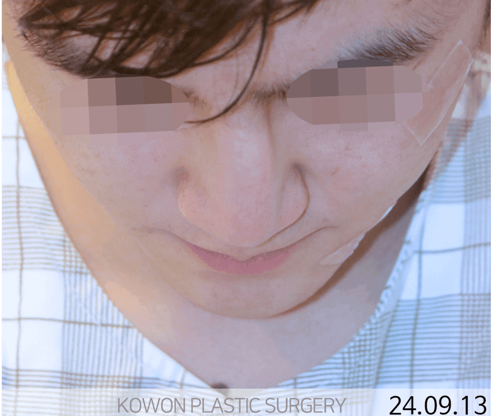 휜코수술, 어디서부터 시작해야 할까 — 비중격을 먼저 세우는 이유와 늑연골 선택 관련 이미지 4/8