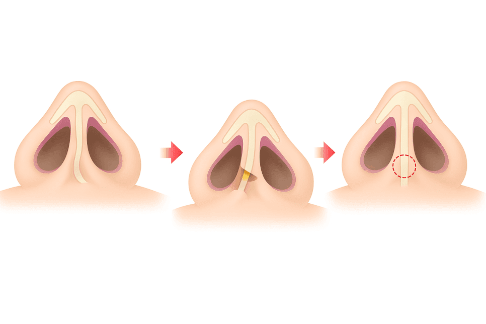 휜코수술, 어디서부터 시작해야 할까 — 비중격을 먼저 세우는 이유와 늑연골 선택 관련 이미지 5/8