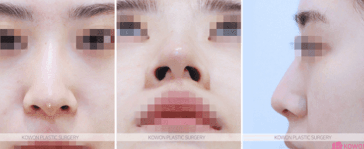 휜코성형과 양악수술, 어느 쪽을 먼저 해야 할까 — 순서와 원인부터 확인하는 이유 관련 이미지 3/9