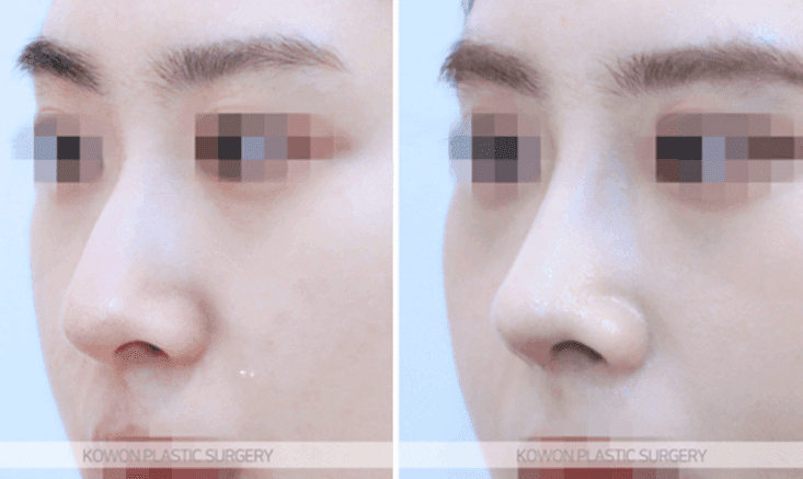 휜코성형과 양악수술, 어느 쪽을 먼저 해야 할까 — 순서와 원인부터 확인하는 이유 관련 이미지 5/9