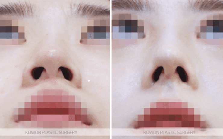 휜코성형과 양악수술, 어느 쪽을 먼저 해야 할까 — 순서와 원인부터 확인하는 이유 관련 이미지 7/9