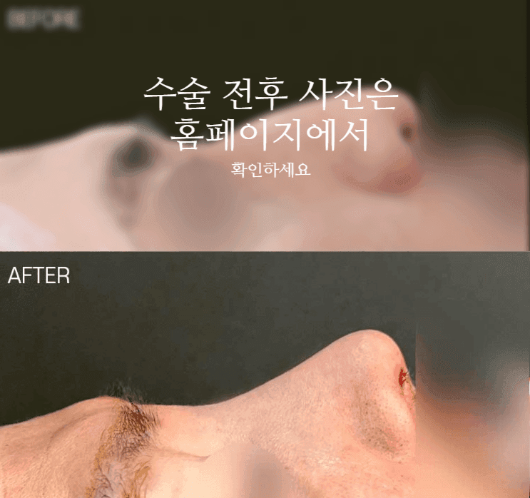 비중격만곡증 수술 회복기간과 매부리·휜코를 함께 교정하는 이유 관련 이미지 2/11