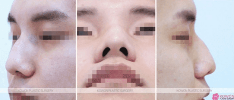 비중격만곡증 수술 회복기간과 매부리·휜코를 함께 교정하는 이유 관련 이미지 6/11