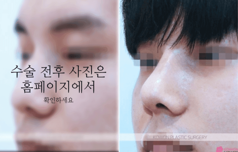 비중격만곡증 수술 회복기간과 매부리·휜코를 함께 교정하는 이유 관련 이미지 7/11