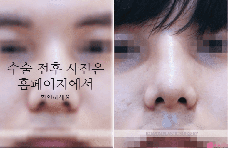 비중격만곡증 수술 회복기간과 매부리·휜코를 함께 교정하는 이유 관련 이미지 8/11