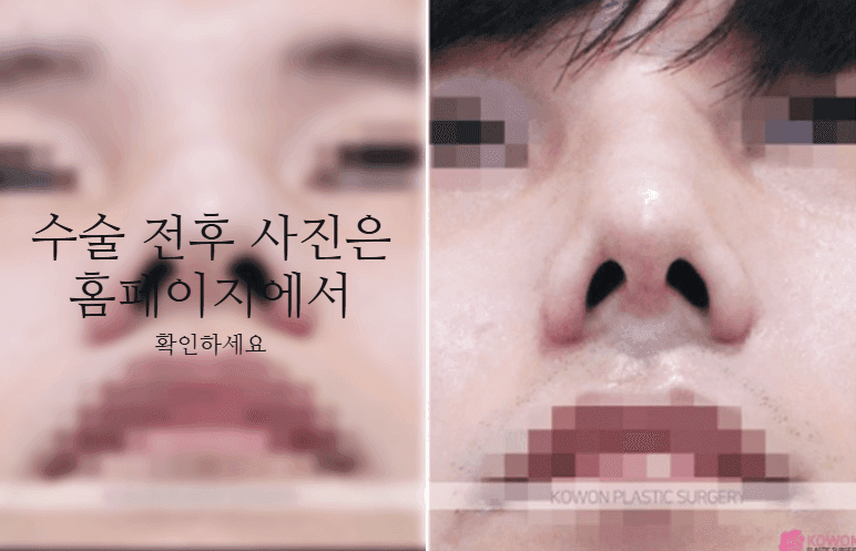 비중격만곡증 수술 회복기간과 매부리·휜코를 함께 교정하는 이유 관련 이미지 9/11